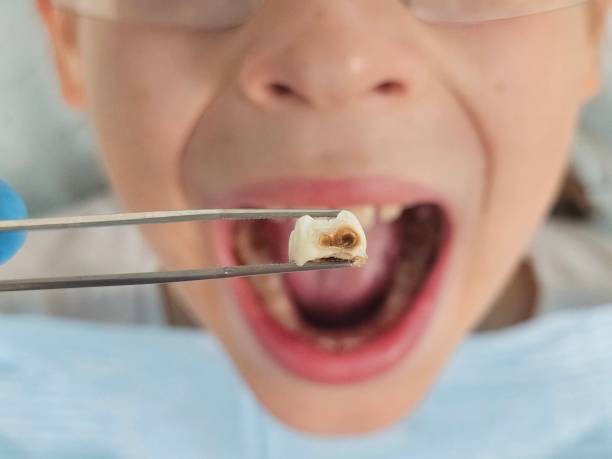 Best Emergency Wisdom Tooth Extraction in Mexico Beach, FL